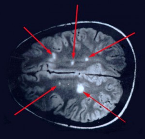 sclerosis