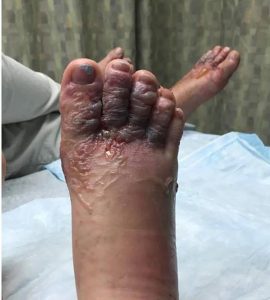 Ministerio de Salud evalúa riesgo larva migrans cutánea en área de Bávaro